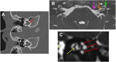 Neuroinflammatory disorders of the brain and inner ear: a systematic review of auditory function in patients with migraine, multiple sclerosis, and neurodegeneration to support the idea of an innovative ‘window of discovery’